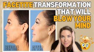 Get a Non-Surgical Facelift with FaceTite