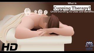 Cupping Therapy The Art of Natural Healing