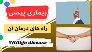 بیماری پیسی و راه های درمان آن Vitiligo disease