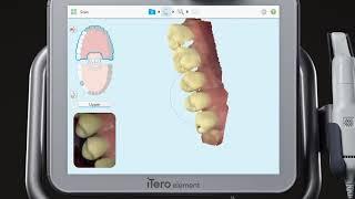 iTero® Scanner Tutorial Charting and Scanning for an Implant