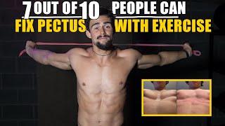 Fix Pectus Without Surgery at fixpectus.com