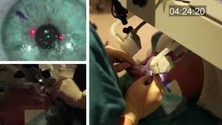 Real-time uncut unedited LASIK procedure live with real sound