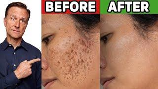 How to Get Rid of Hyperpigmentation Aging or Dark Spots