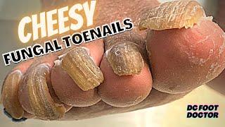 Cheesy Fungal Toenails Trimming Long Toenails