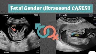Its baby boys Day  Gender Compilations @ various weeks Ultrasound cases