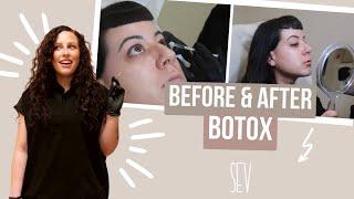 Botox Treatment Before and After