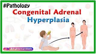 Congenital adrenal hyperplasia  Etiology Pathophysiology Clinical features Diagnosis Treatment