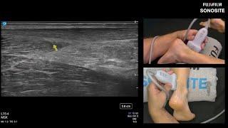 Webinar Using Ultrasound to Evaluate the Posterior Ankle