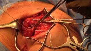 Pectoralis Major Tendon Repair Brief Review and Surgical Technique