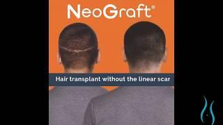 Hair Restoration for Men in Connecticut with NeoGraft