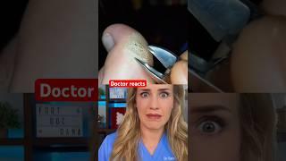 Doctor reacts foot callus art?