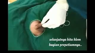 Cara Memotong PREPUTIUM dengan CouterLaser