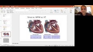 Ventricular Arrhythmias EP Webinar with Dr. Verma