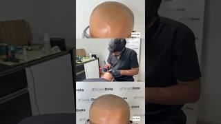 Scalp Micropigmentation Benefits Side Effects Before & After Pics by Dr Varun Nambiar