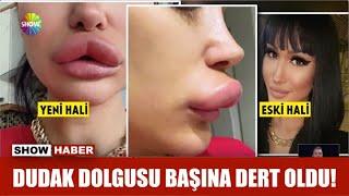 Dudak dolgusu başına dert oldu