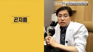 곤지름성기 사마귀 증상과 냉동치료법