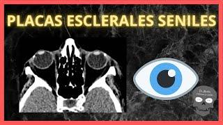 PLACAS ESCLERALES Seniles Calcificadas en TOMOGRAFÍA ️