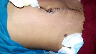 Operasi infeksi usus buntu yang terlambat