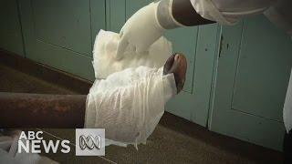 Maggot therapy experiences renaissance in African hospitals 2015  ABC News