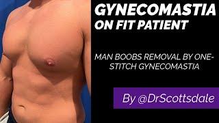 How to get rid of your man boobs permanently? By @DrScottsdale