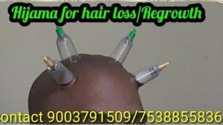 Hijama for hair loss and RegrowthTk health tipsDr.TKCupping Therapy for hair.