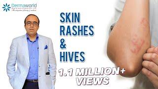 Why does Skin Rash Hives Urticaria happen?  Dr Rohit Batra explains