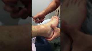 Graston Technique on a grade 2 ankle sprain