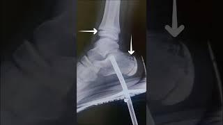 Impaled Foot