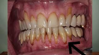 Correct Gum Recession With AMAZING Results - The Pinhole Technique