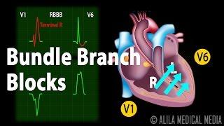Bundle Branch Block Animation.
