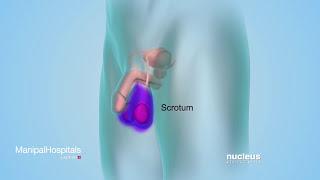 Male Infertility  Semen Analysis and Donation  Semen Analysis Test - Manipal Hospitals