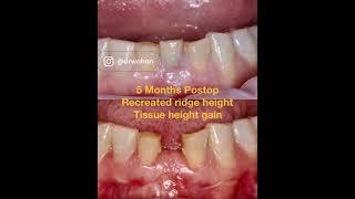 Horizontal and Vertical Ridge Augmentation Straumann 2.9mm Dental Implant