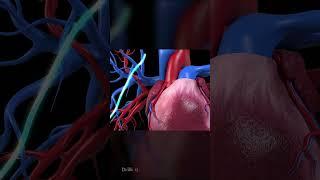 Single Heart Bypass Surgery 3D Animation