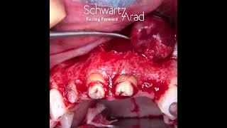 Radicular Cyst