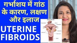 गर्भाशय में गांठ का इलाज  Uterine Fibroids best treatment in hindi