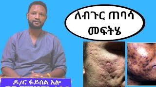 የ ብጉር ጠባሳ ህክምና Microneedling - Acne Scar Treatment in Amharic - Dr. Feysel on TenaSeb