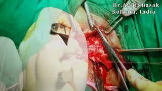 Cystocele & Rectocele Repair by Dr.Avijit Basak Pelvic floor repair PFR after Hysterectomy