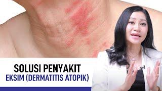 Eksim Dermatitis Atopik Penyebab Gejala dan Cara Mengatasinya