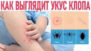 УКУС КЛОПА  Как он выглядит и чем его смазывать и как избавиться от клопов