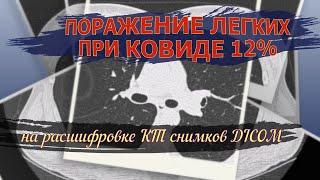 Расшифровка КТ легких при ПНЕВМОНИИ двусторонней с ПОРАЖЕНИЕМ легких при КОВИДЕ 12% тяжестью КТ 1