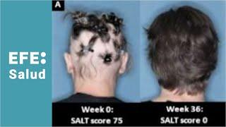 Alopecia Areta objetivo de la dermatología top