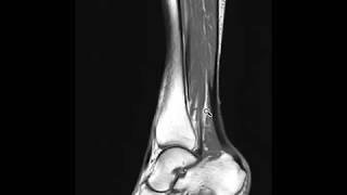 Sinus tarsi syndrome and peritendinitis of ankle.