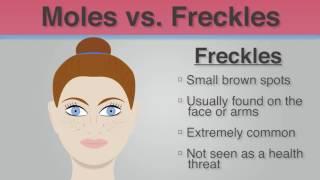 Did You Know - The Difference Between Moles & Freckles