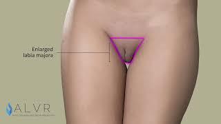 Labia Majora Reduction Animation - Front View