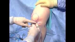 Arthroscopic Knee Surgery Video Part 3 Anatomy of the Knee  Albuquerque Knee Specialist