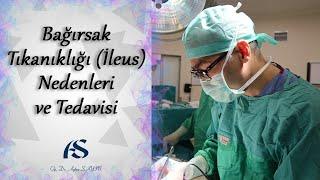 Bağırsak Tıkanıklığı İleus Nedenleri ve Tedavisi