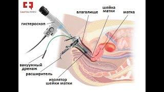 Миома матки лечение гистероскопической энуклеацией или операция удаления лазером
