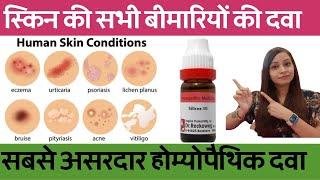 All Skin Diseases Homeopathic Medicines  Acne Eczema Psoriasis Urticaria Impetigo Ringworm
