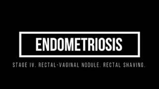 Stage IV endometriosis. Rectal-Vaginal Nodule. Rectal Shaving.