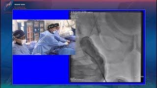 Right External Iliac CTO of Common Femoral Artery - LINC 2018 Live Case - Tues 145pm